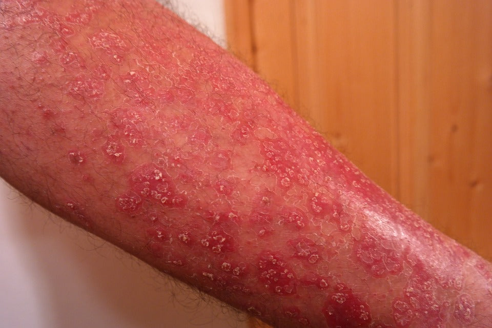 PSORIASI…AHI AHI AHIIII!!!!
